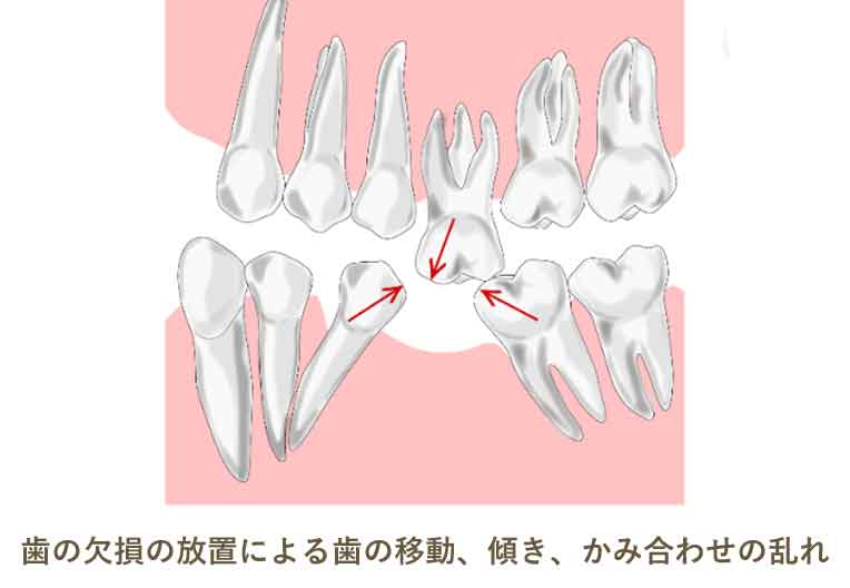 歯の欠損の放置による歯の移動、傾き、かみ合わせの乱れ