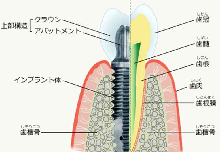 インプラントの構造