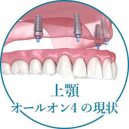 上顎オールオン4の現状