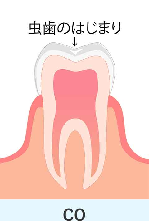 エナメル質表層のごく初期のむし歯