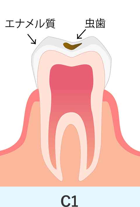 エナメル質のむし歯