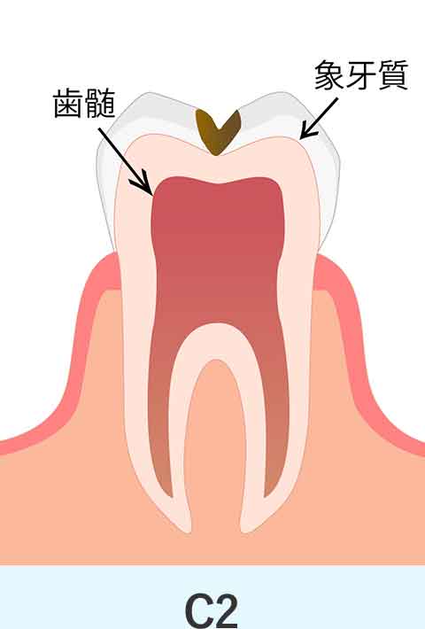 象牙質のむし歯