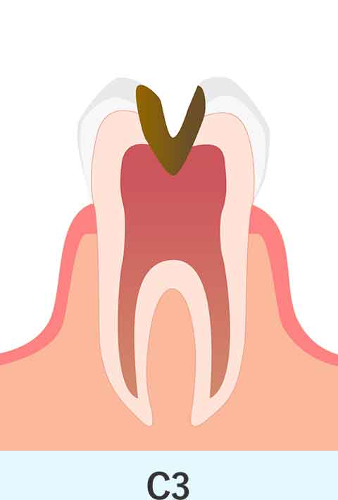 歯の神経まで到達しているむし歯