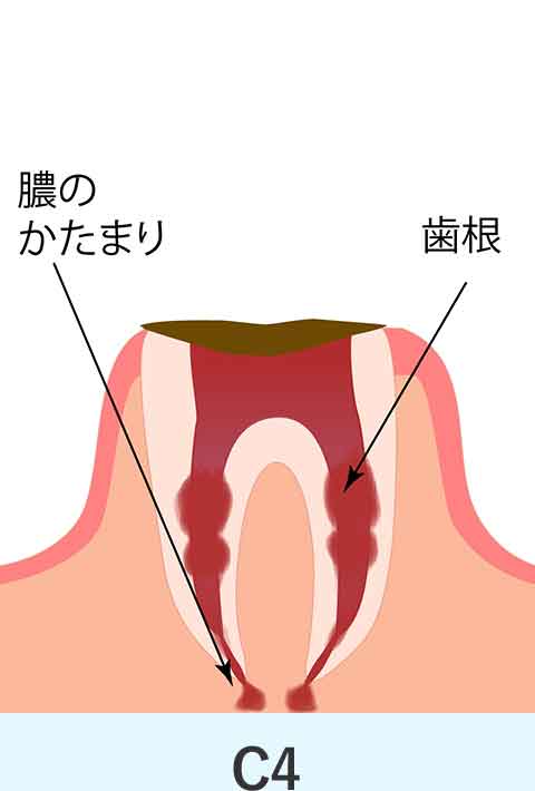 崩壊が進み根っこだけになっているむし歯