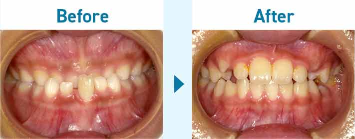 お子様の矯正治療―反対咬合