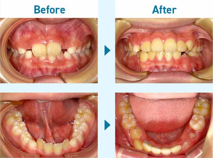 お子様の矯正治療―叢生