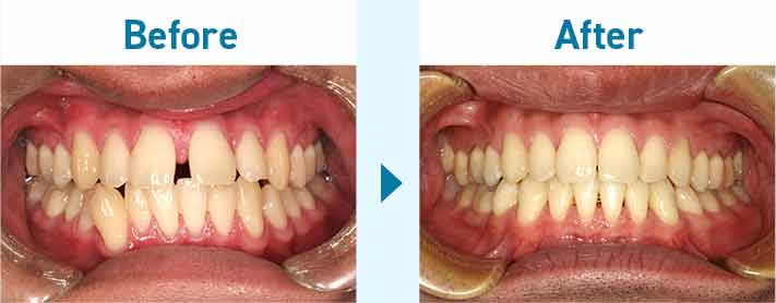 大人の矯正治療―空隙歯列と叢生