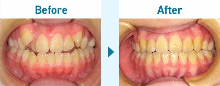 大人の矯正治療―叢生