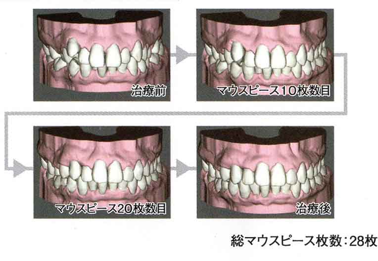 治療期間を事前に知ることができる