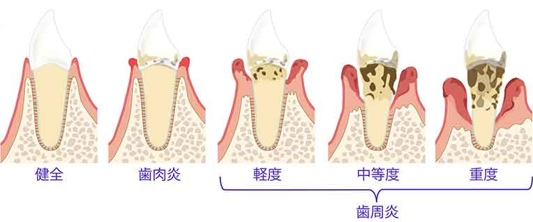 進行度による歯周病の分類