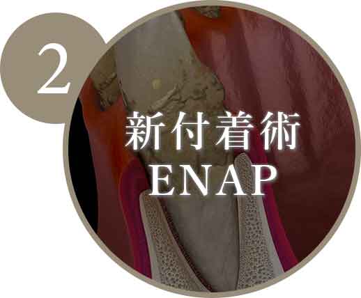 新付着術ENAP