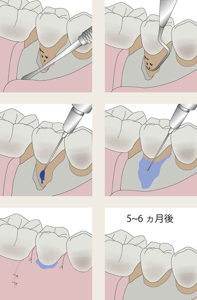 歯周外科治療