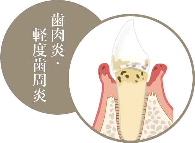 一般的な歯肉炎・軽度歯周炎の場合