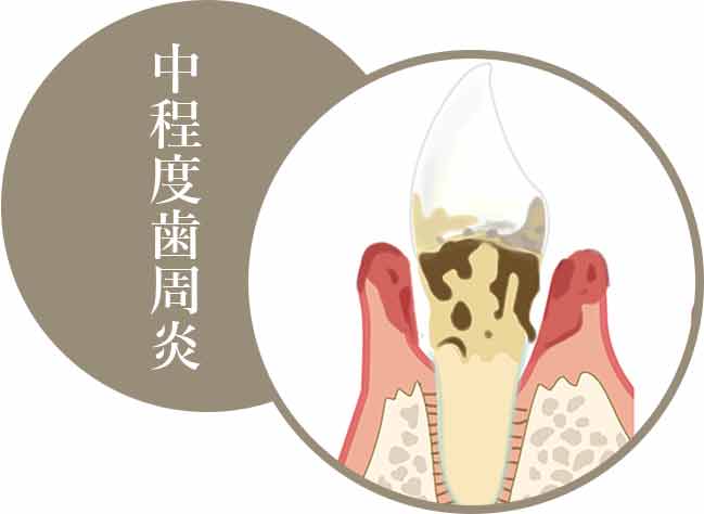 中程度歯周炎の場合